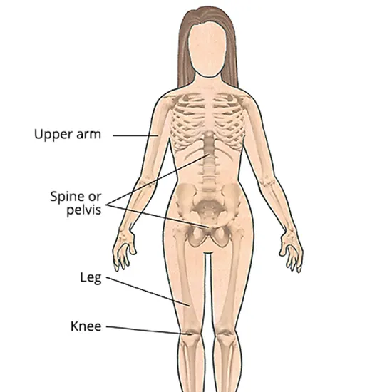 Bone Tumor (Sarcomas): Types, Causes, Diagnosis & Treatment